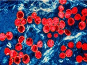 Bệnh đậu mùa mpox ảnh hưởng nghiêm trọng hơn tới người mắc HIV tiến triển